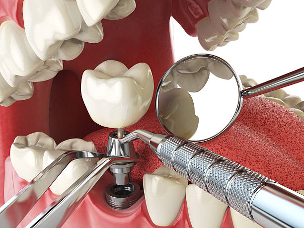 Best Lost Filling or Crown Replacement in Newmanstown, PA